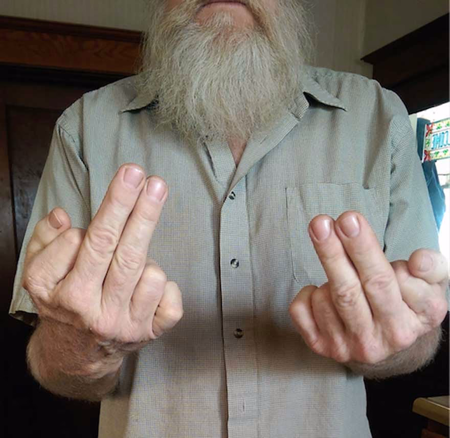 iki elinde de 2 orta parmağı var