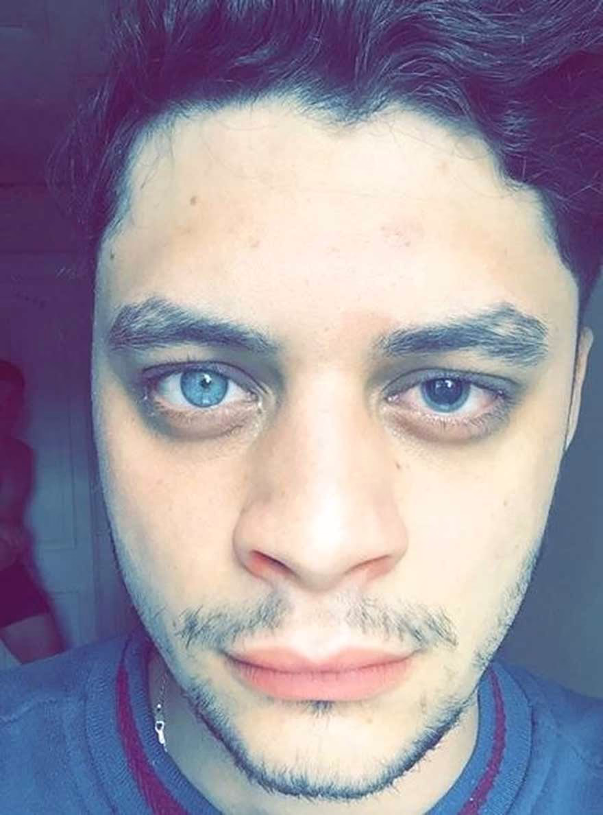 Anisocoria 
